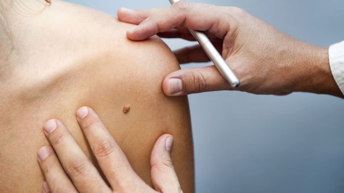 Málaga lidera en España el ensayo de la primera vacuna personalizada contra el melanoma con resultados positivos – Cadena SER